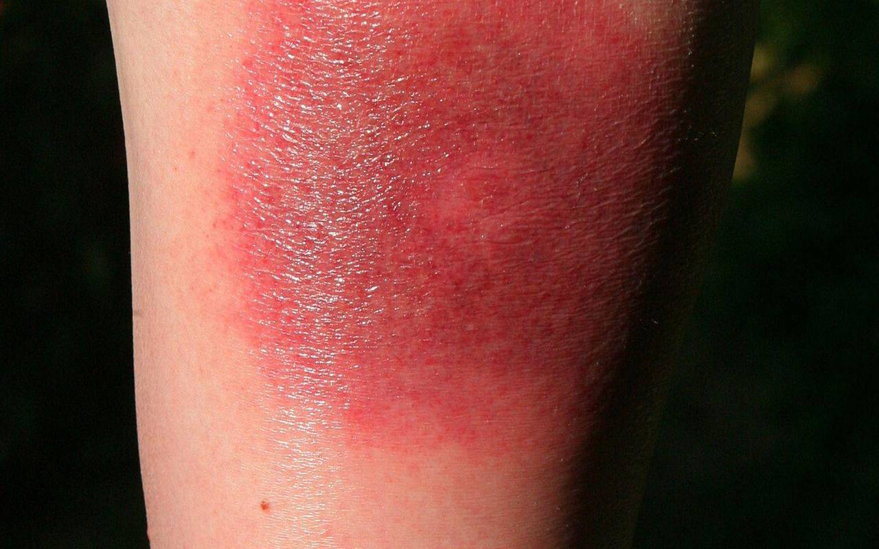 Wade nach Zeckenstich